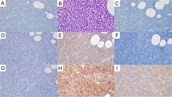 Fig. 2: Mantle cell lymphoma without EZH2 expression (EZH2(−) MCL.
