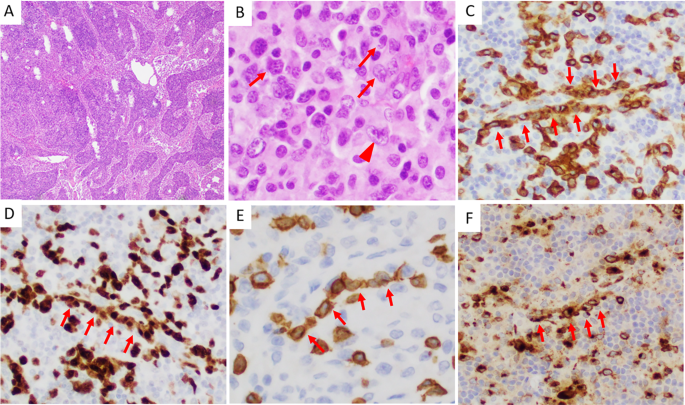 Fig. 1: An ALK + ALCL case with small cell pattern partially involving lymph node.