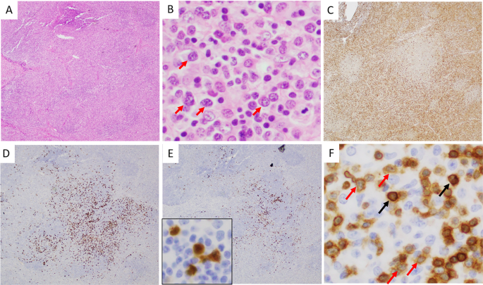 Fig. 3: An ALK + ALCL case with a lymphohistiocytic pattern.
