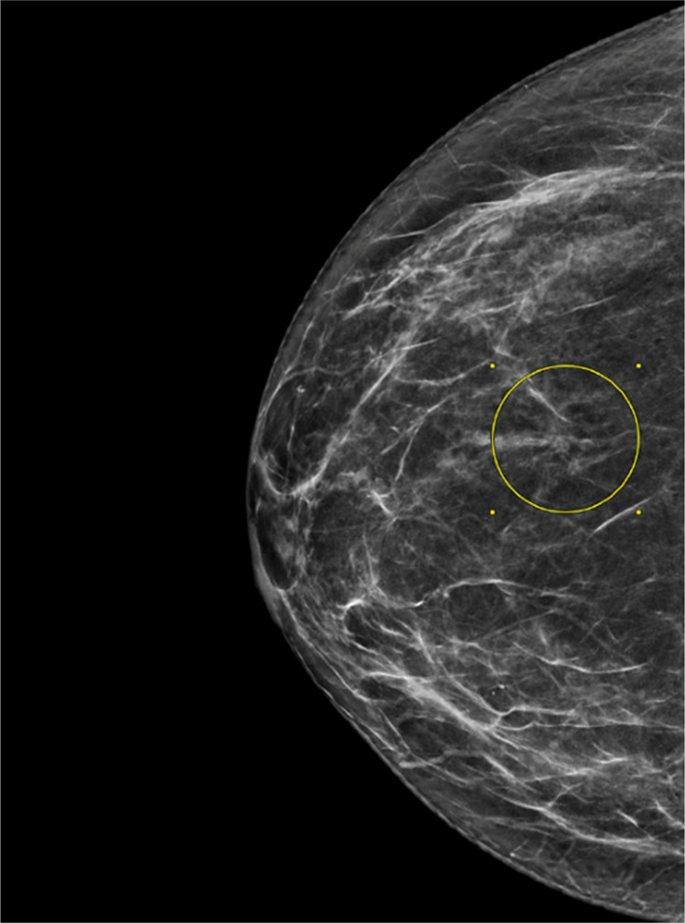 New scoring system for 'second look' breast lesions could decrease biopsies  by 30% or more