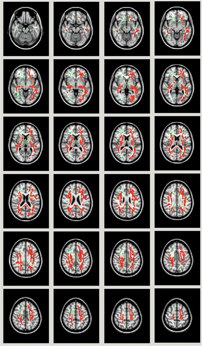 glutathione psychosis Extracellular free water and glutathione in first-episode psychosis—a  multimodal investigation of an inflammatory model for psychosis