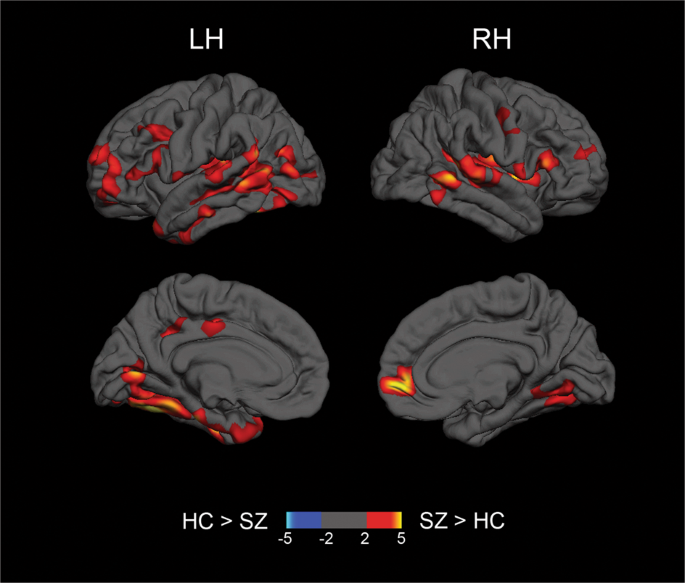 glutathione psychosis FAB: Antioxidants in brain linked to improved psychosis treatment main image 1