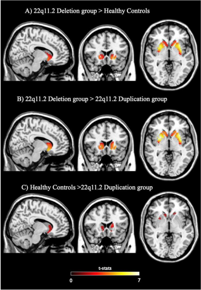 Fig. 3: Voxelwise comparison of Striatal Dopamine Synthesis Capacity between groups.