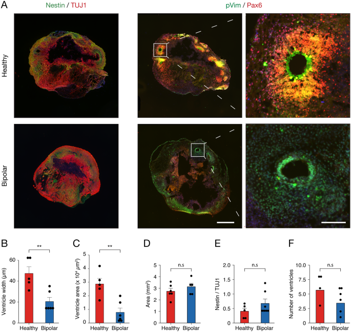 Bipolar disorder-iPSC derived neural progenitor cells exhibit 