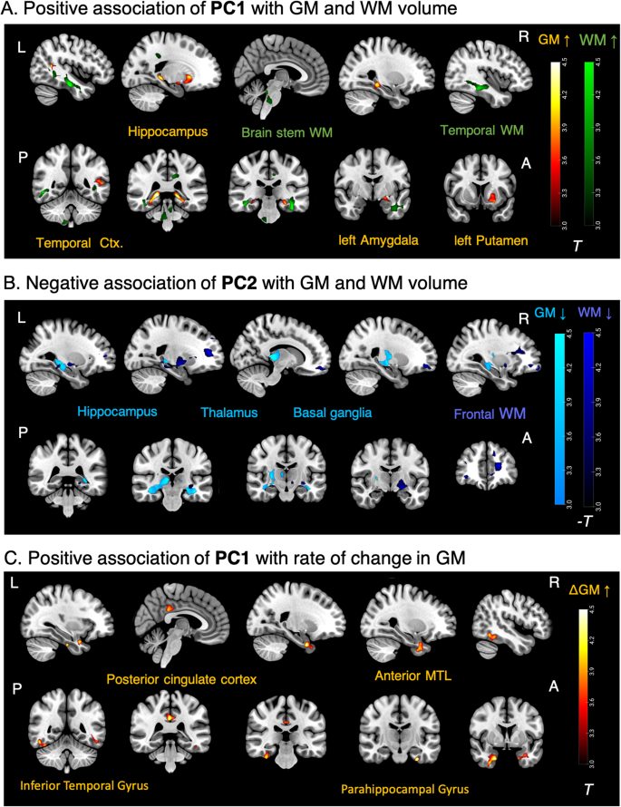 Fig. 3: Whole-brain voxel-wise regression of brain volumes and rate of volume change on inflammatory components.