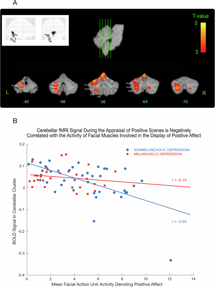 Fig. 5: Cerebellar clusters covary negatively with mean positive facial action unit activity.