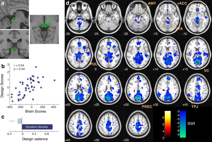 Fig. 2: Partial least squares correlation (PLS-C) analysis of superior colliculus (SC) whole-brain functional connectivity with age and symptom severity in 46 children with ASD.