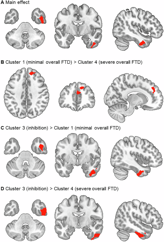 Fig. 3: Associations of FTD clusters with gray matter volume.