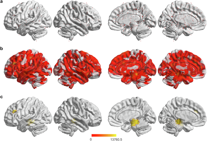 Fig. 1: Brain regions showing increased brain activity associated with panic disorder.
