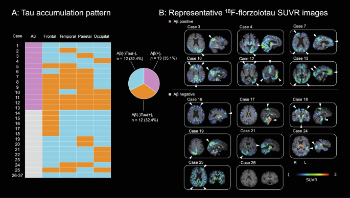 Representative florzolotau (18F) tau PET images from patients with late-onset psychosis, showing varied regional accumulation patterns