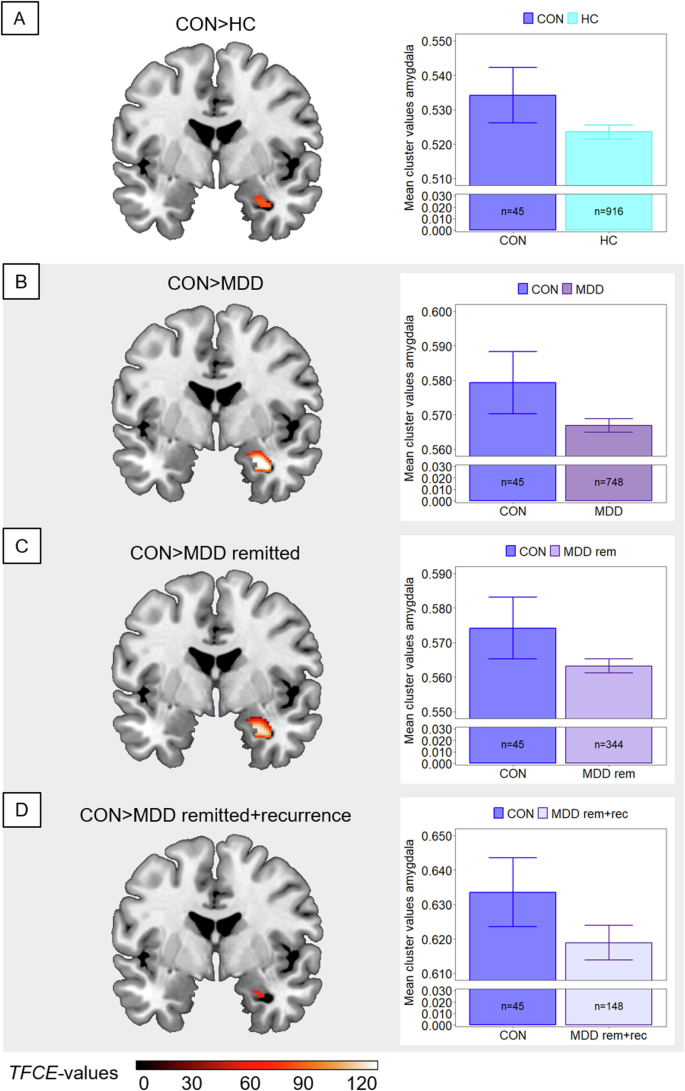 Brain structural correlates of an impending initial major depressive episode