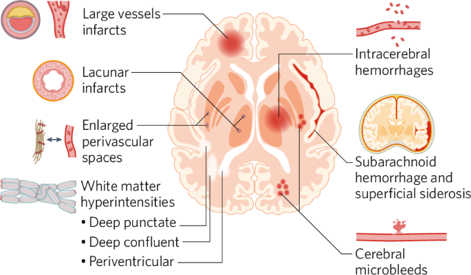 Fig. 1: Cerebrovascular disease lesions.