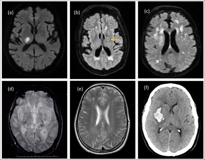 Fig. 2: Imaging appearances of age-related non-amyloid SVD.