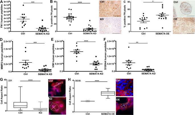 Postpartum breast cancer progression is driven by semaphorin 7a-mediated  invasion and survival | Oncogene