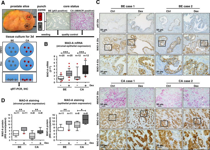 Fig. 3: Evaluation of MAO-A expression in benign and cancerous tissue cores of RPE patients after GC treatment.