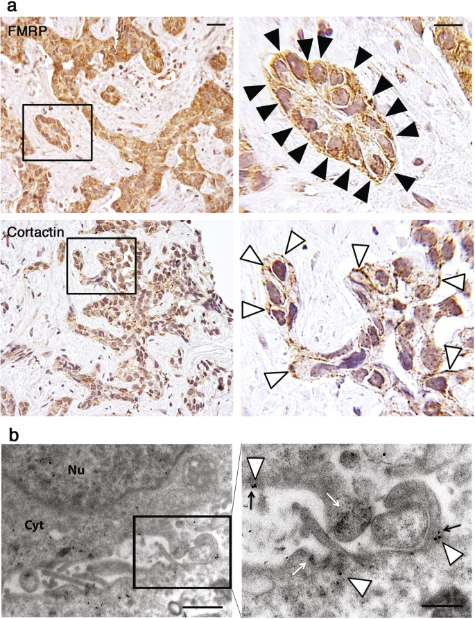 Fig. 2: Immunohistochemical and ultrastructural localization of FMRP at the leading edge in iCCA cells.