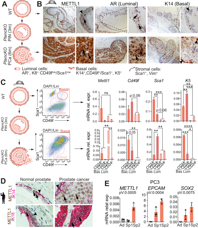 Fig. 5: High expression of METTL1 in PCa.