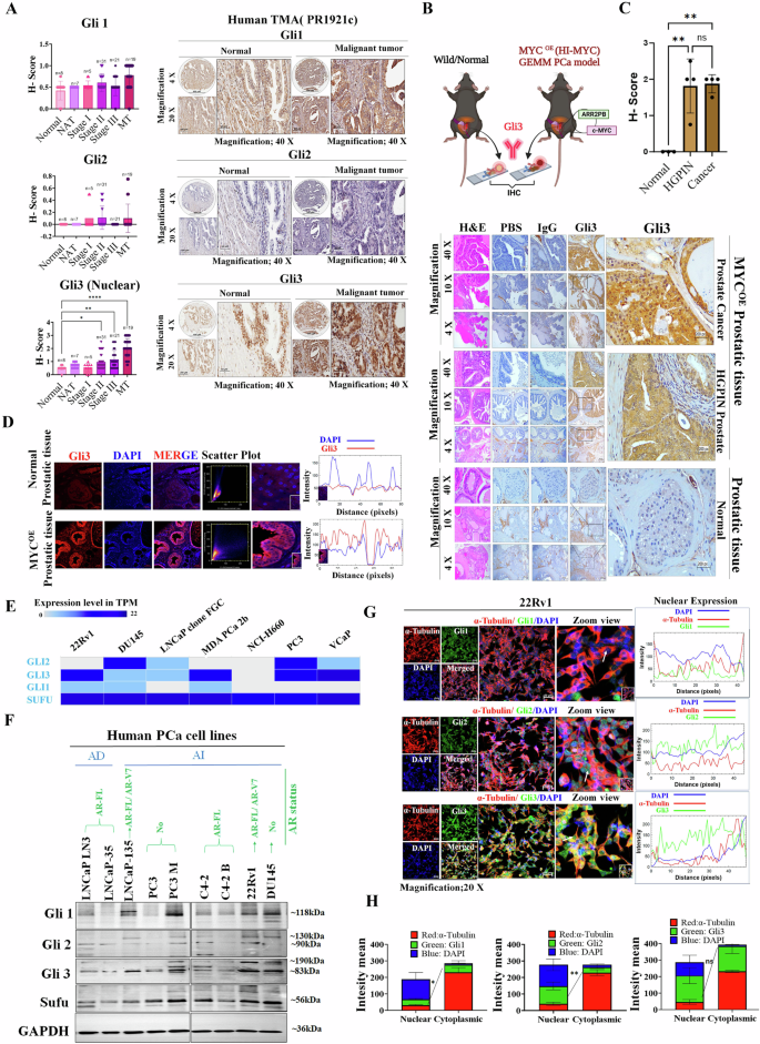 Fig. 1: Expression profile Gli-family proteins, with emphasis on t-Gli3 in advanced PCa.