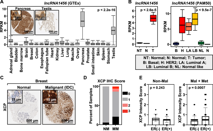 Fig. 2: Expression of lncRNA1456 RNA and XCP peptide in human normal and breast cancer tissues.