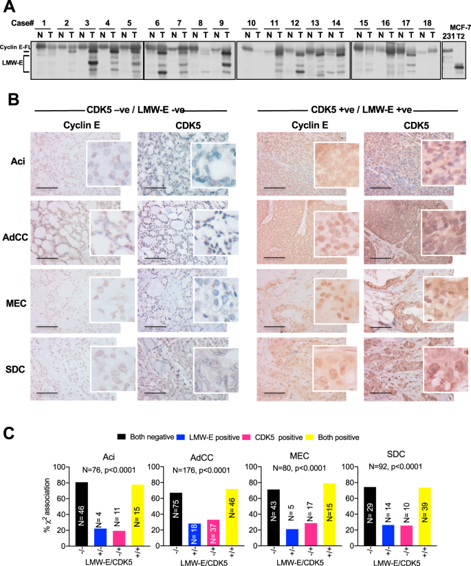 Fig. 4: LMW-E and CDK5 are co-expressed in human salivary gland tumors.
