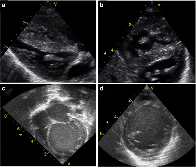 Application of Neonatologist Performed Echocardiography in the ...