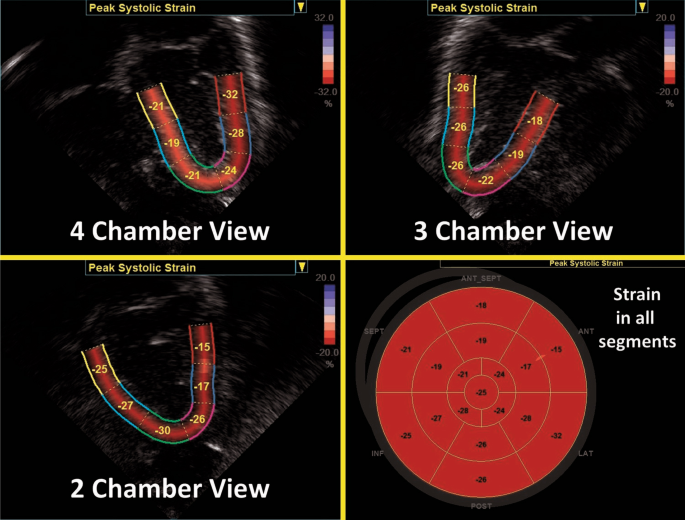 Global longitudinal strain: Bull's Eye Map. Global longitudinal