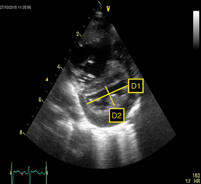 Application of Neonatologist Performed Echocardiography in the assessment  and management of persistent pulmonary hypertension of the newborn |  Pediatric Research