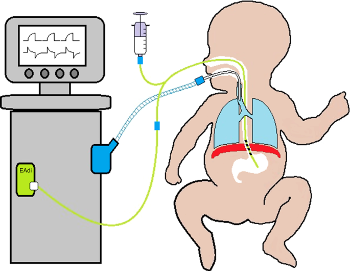 Modes and strategies for providing conventional mechanical ventilation in  neonates | Pediatric Research