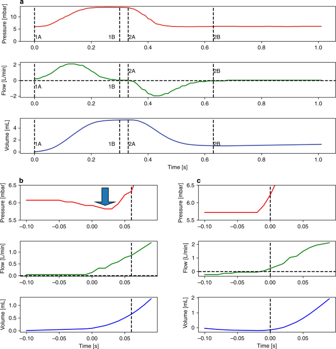 Computational analysis of neonatal ventilator waveforms and loops |  Pediatric Research
