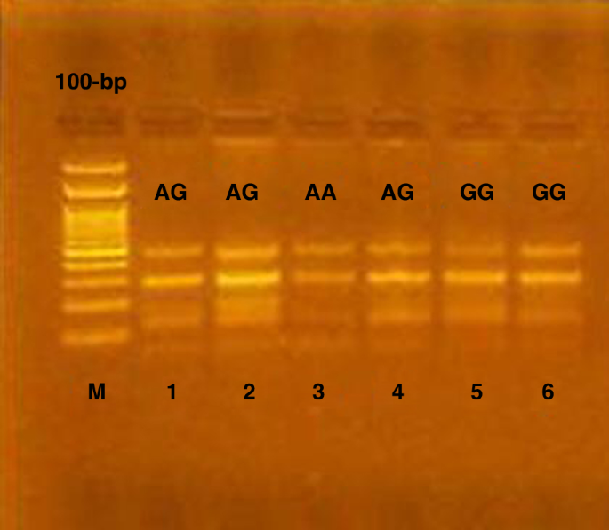 Association between Interleukin-17F 7488A/G and 7383A/G polymorphisms and susceptibility to juvenile idiopathic arthritis | Pediatric Research da-1380-fill-out-sign-online-dochub