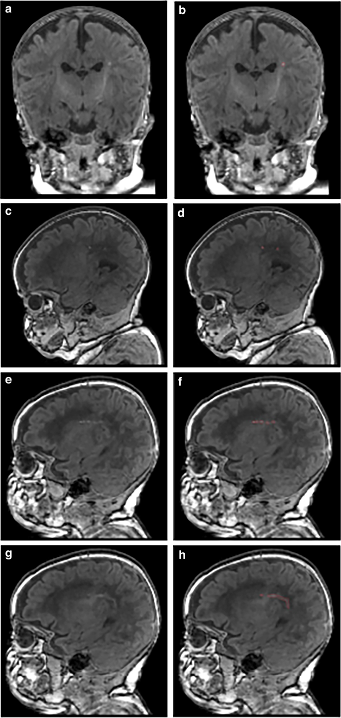 Fig. 1: Punctate white matter lesions (PWML) with varying degrees of severity displayed using raw and segmented T1-weighted MRI scans (1 mm resolution) at term-equivalent age in three preterm infants.