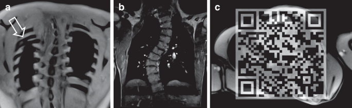 Fig. 1: Anatomical deformities after open EA repair.