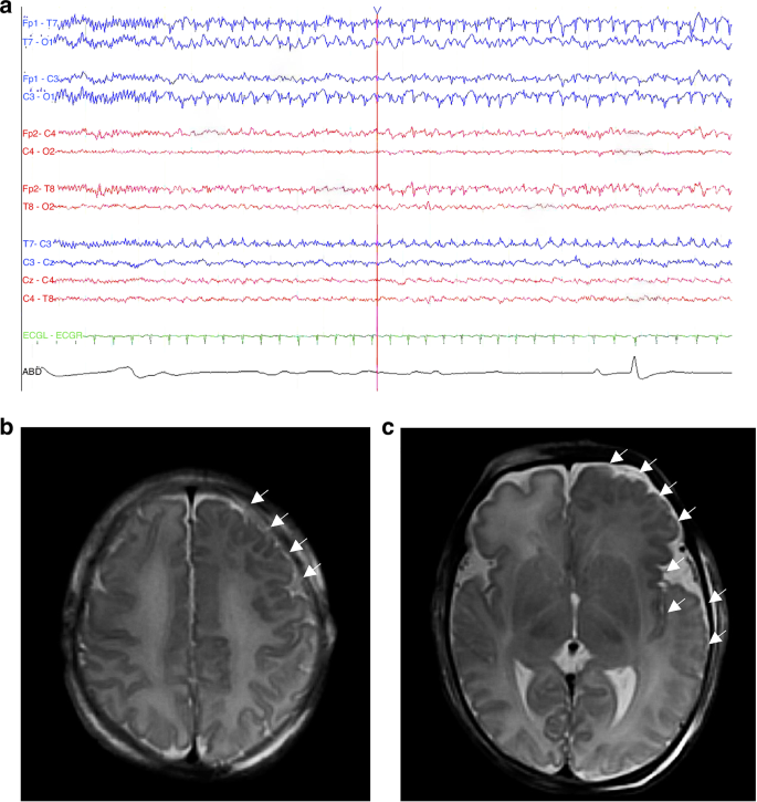 Fig. 1: Term infant with hemimegalencephaly, initially presenting with neonatal encephalopathy and treated with therapeutic hypothermia for possible hypoxic-ischemic encephalopathy.