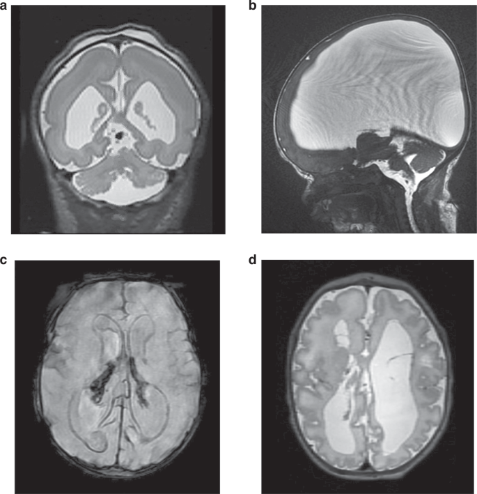Fig. 2: Examples of neonatal MRI findings in selected genetic disorders with initial prenatal presentation.