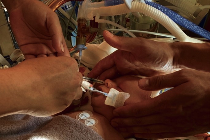 Fig. 1: Intranasal breast milk administration by parents in a mechanically ventilated neonate.