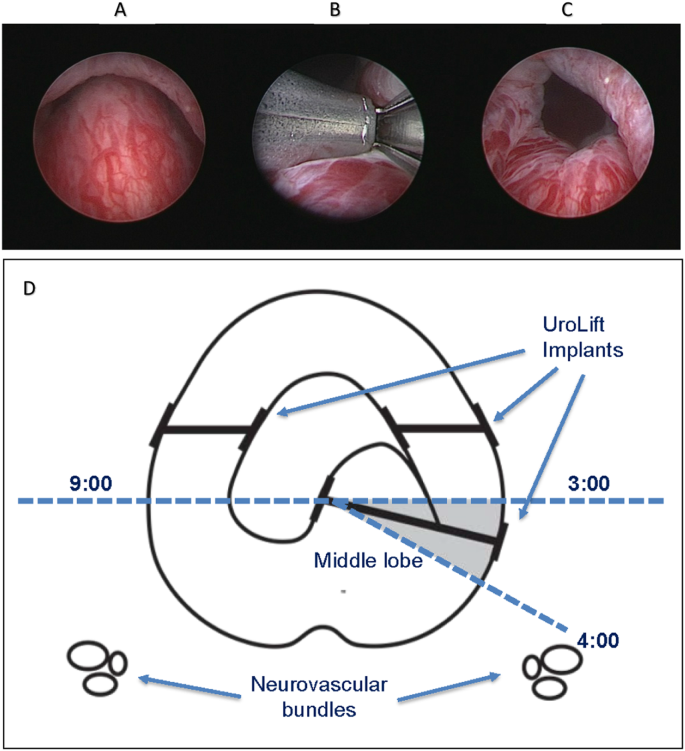 picture of median lobe of prostate