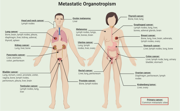 metastatic cancer is