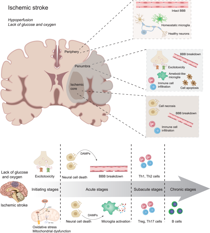 ischemic stroke pathophysiology