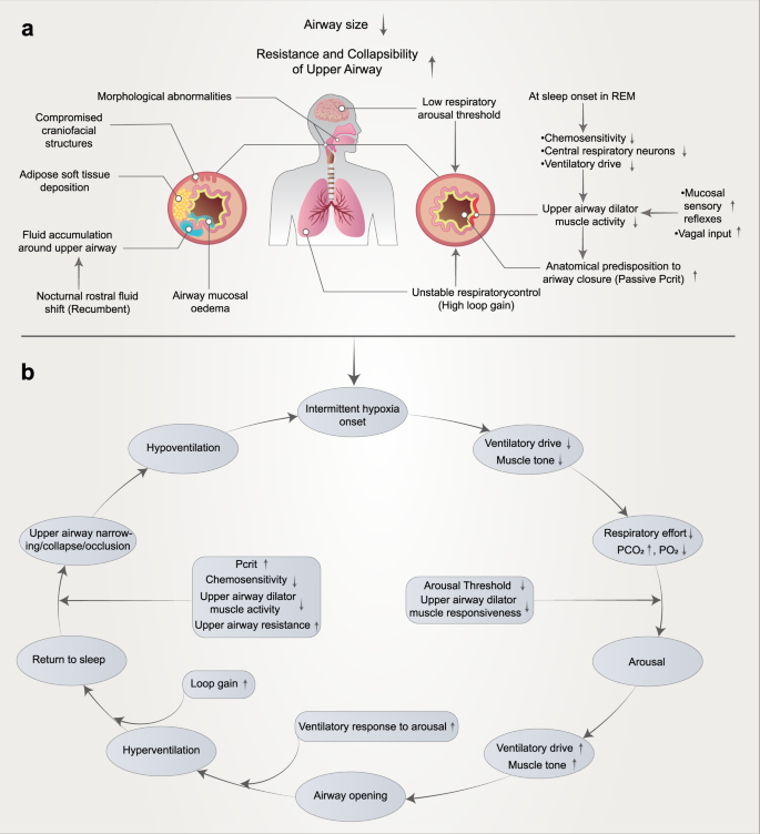 Pathophysiological mechanisms and therapeutic approaches in obstructive  sleep apnea syndrome | Signal Transduction and Targeted Therapy