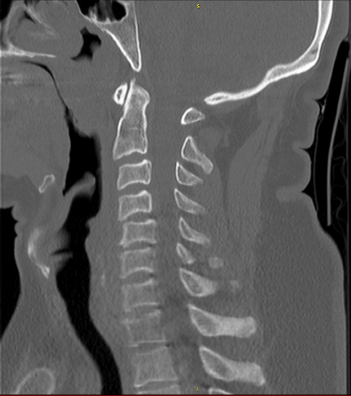 Atypical hangman's fracture with concomitant subaxial fracture–dislocation  treated with circumferential fusion of C2–C5—a case report | Spinal Cord  Series and Cases