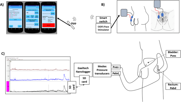 Ambulatory Urodynamic Monitoring Assessment Of Dorsal Genital Nerve Stimulation For Suppression Of Involuntary Detrusor Contractions Following Spinal Cord Injury A Pilot Study Spinal Cord Series And Cases