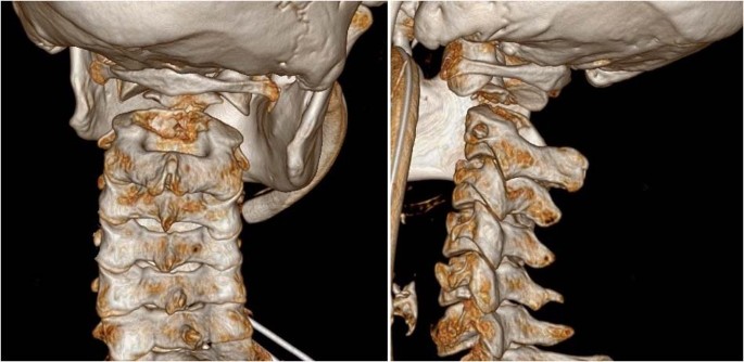 type 3 odontoid fracture type 3 odontoid fracture