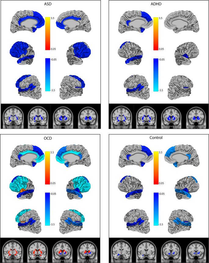 Structural neuroimaging correlates of social deficits are similar in autism  spectrum disorder and attention-deficit/hyperactivity disorder: analysis  from the POND Network | Translational Psychiatry