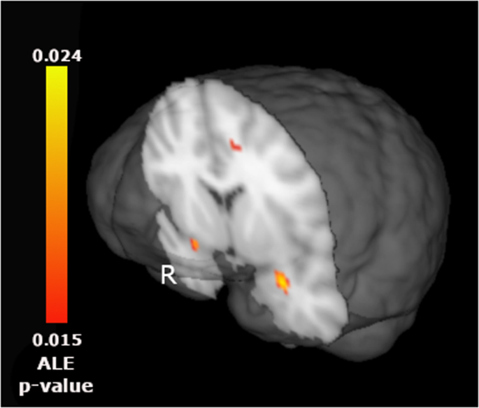 borderline personality disorder brain abnormalities