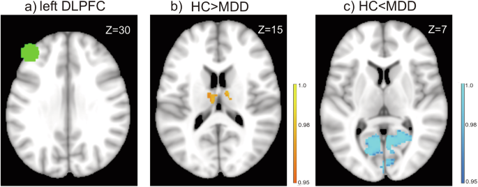Fig. 2: Regions which showed abnormal FC with the left DLPFC in MDD.