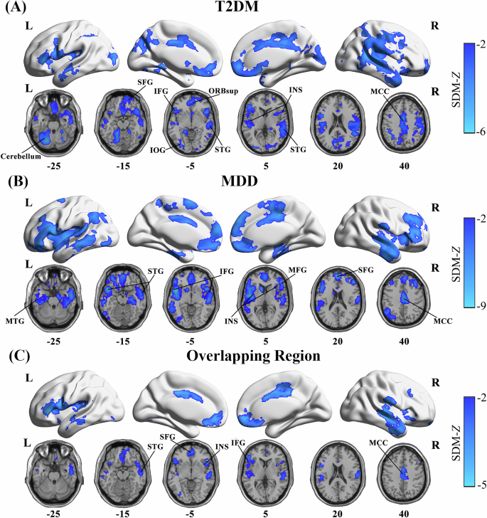 Fig. 3: GMV reductions identified through meta-analyses of T2DM and MDD, as well as their overlap.