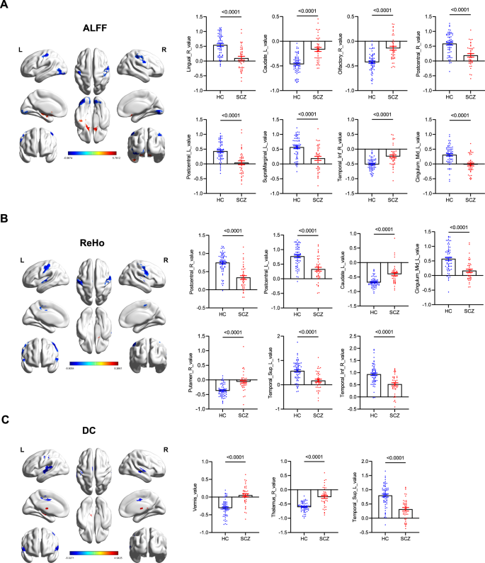 Fig. 3: Functional magnetic resonance imaging (fMRI) analysis in schizophrenia patients and healthy controls.
