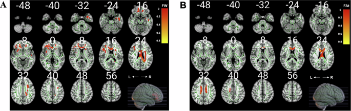 Fig. 4: Association of DTI-ALPS with free water and FA-t in white matter tracts.
