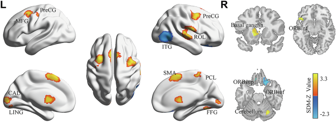 Fig. 2: The results of meta-analysis comparing sequential and random conditions related brain activation.
