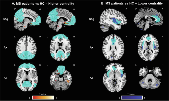 Fig. 1: SPM12 analysis showing voxel-wise differences in centrality between MS patients and HC.